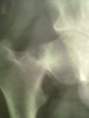 Case 1: Preoperative x-ray