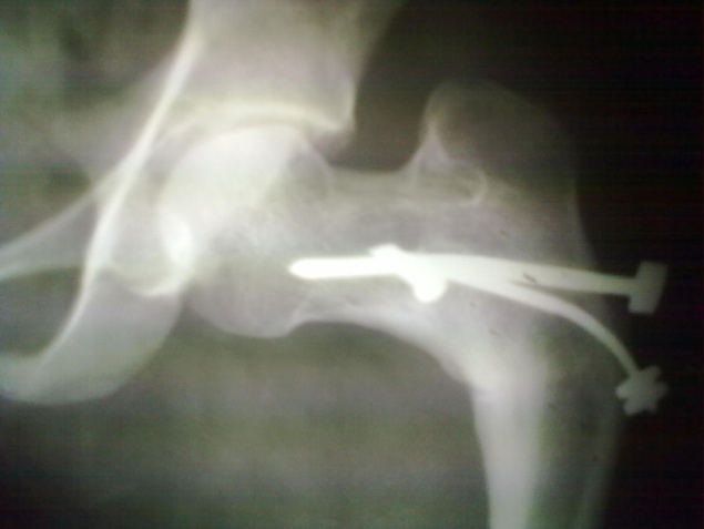 Case 4: Coxa vara with bending of implant