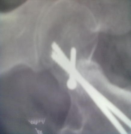 Case 1: Postoperative at 6 weeks