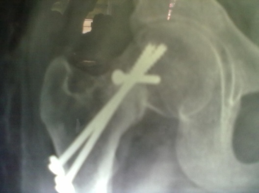Case 1: Postoperative x-ray at 10 week AP view