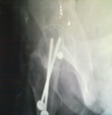 Case 1: Postoperative x-ray at 10 week lateral view