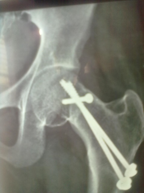 Case 1: Postoperative at 16 weeks