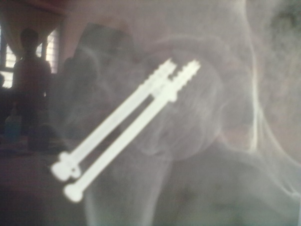case 2: Postoperative x-ray at 16 weeks