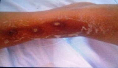 Rash over right lower leg
