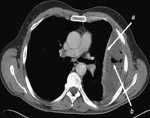 CT scan thorax depicting left pleural effusion