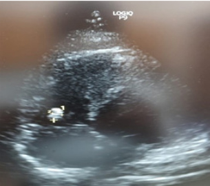 Transthoracic echocardiography showing vegetation over tricuspid valve