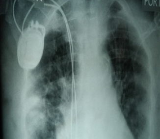 Chest X-ray showing right lungs infiltrates and pulse generator and lead of permanent pacemaker 