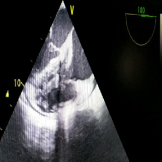 Transesophageal echocardiography showing large vegetation on pacemaker lead