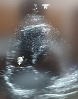 Transthoracic echocardiography revealing vegetation over tricuspid value