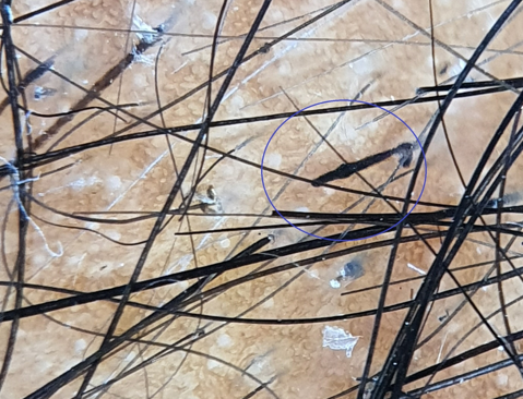 Trichotillomania shows the bulbous dark proximal end with a linear stem resembling a burnt matchstick (Blue circle), (Dermlite DL 4 dermoscope, 10x, polarised)