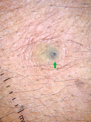 The central pore in epidermal cyst, known as the pore sign (Green arrow) (Dermlite DL4 dermoscope, 10x, non-polarised)