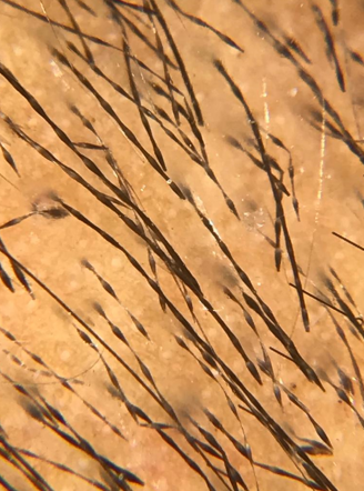 Hair shafts in monilethrix showing uniform and intermittent constrictions with hairs bended regularly at multiple locations (Hiene delta 20T dermoscope, 10x, non polarised) (Pic courtesy- Dr Dipak Agarwalla)