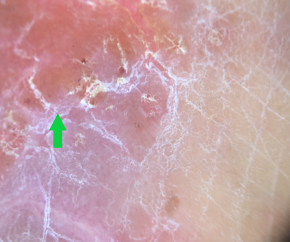 The yellow clod sign seen in nummular eczema (Blue arrow) (Dermlite DL4 dermoscope, 10x, polarised)