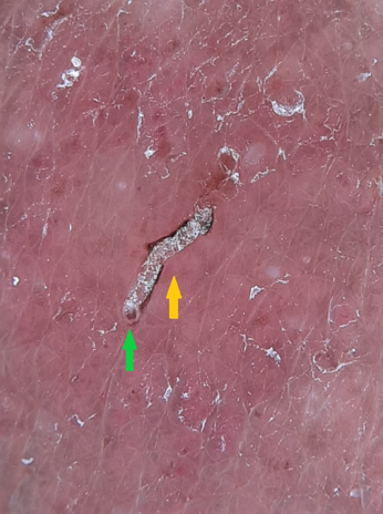 The scabies mite forming the delta wing (globular head- green arrow) with the burrow (s-shaped tunnel- yellow arrow) –delta wing jet with contrail sign (Dermlite DL4 dermoscope, 10x, polarised)