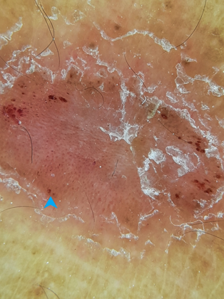 The regular dotted red dot pattern of psoriasis known as the dermoscopic auspitz sign (Blue arrow) (Dermlite DL4 dermoscope, 10x, polarised)