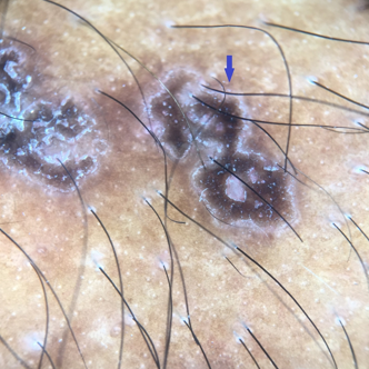 The diamond necklace sign seen in porokeratosis of mibelli (Blue arrow) (Dermlite DL4 dermoscope, 10x, polarised)