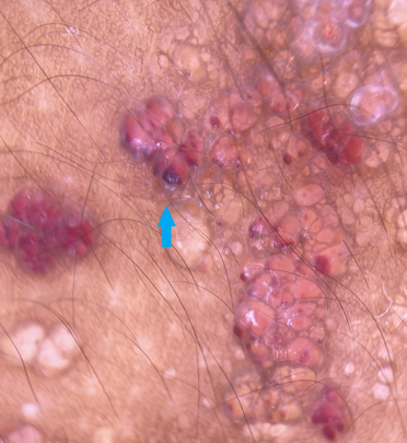Hypopyon sign in lymphangioma circumscriptum due to sedimentation of blood in the lower part of the lacuna (blue arrow) (Dermlite DL4 dermoscope, 10x, polarised)