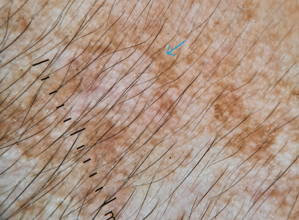 Diffuse brownish pigmentation having concave borders known as the jelly sign (Blue arrows). (Dermlite DL4 dermoscope, 10x, polarised)