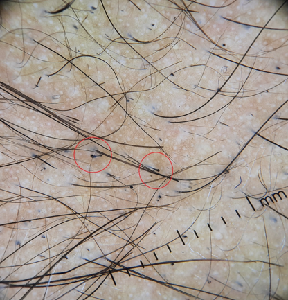 The bulbous distal end of the hair shaft, known as the mace sign (Red circle) (Dermlite DL4 dermoscope, 10x, polarised)