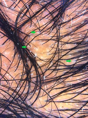 Peripilar sign – White halo around the follicular ostia in androgenetic alopecia (Dermlite DL4 dermoscope, 10x, polarised)