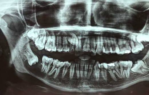 Pre-operative orthopantomogram