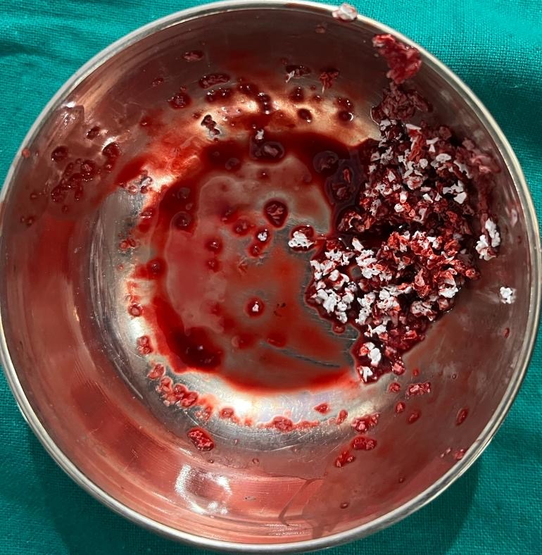 Bovine Noble creos bone graft