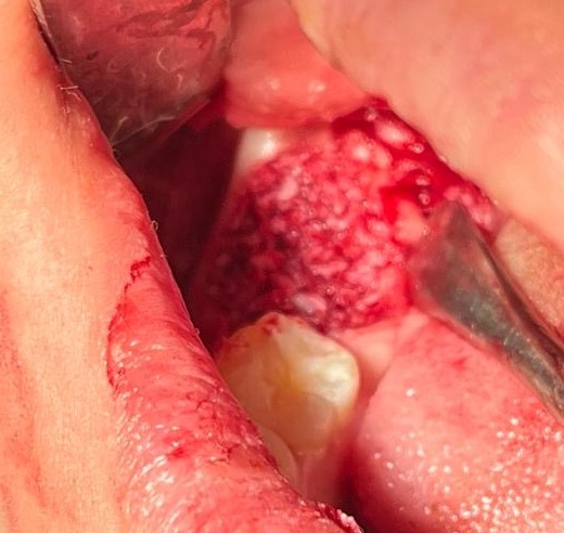 Placement of bone graft
