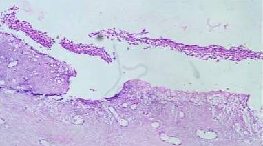 Cystic lining of stratified squamous epithelium