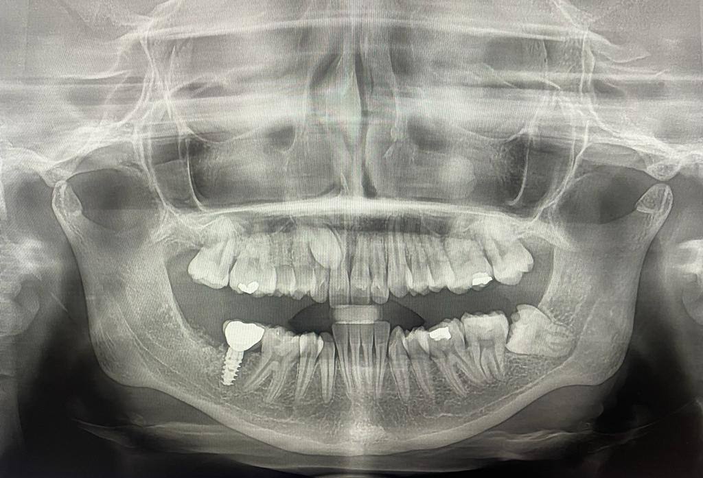 Post- operative orthopantomograph showing bone regeneration taken after six months