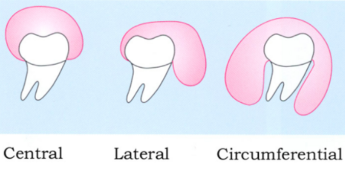 Three radiological variations of dentigerous cyst