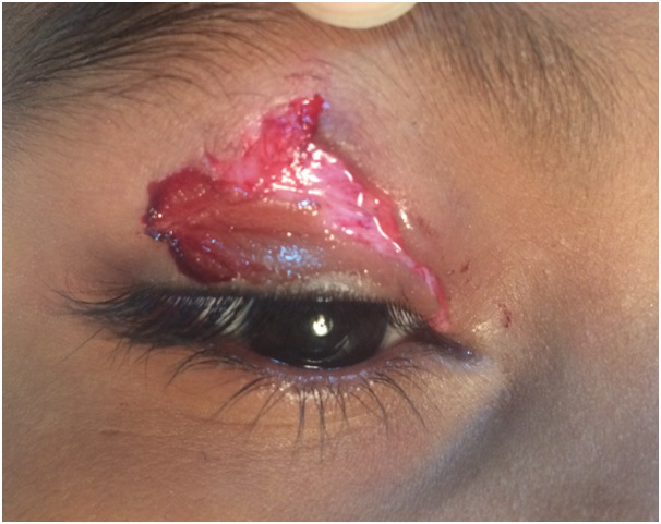 Upper lid laceration extending to upper eyelid margin