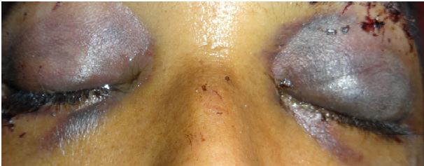 Black eye both eyes
