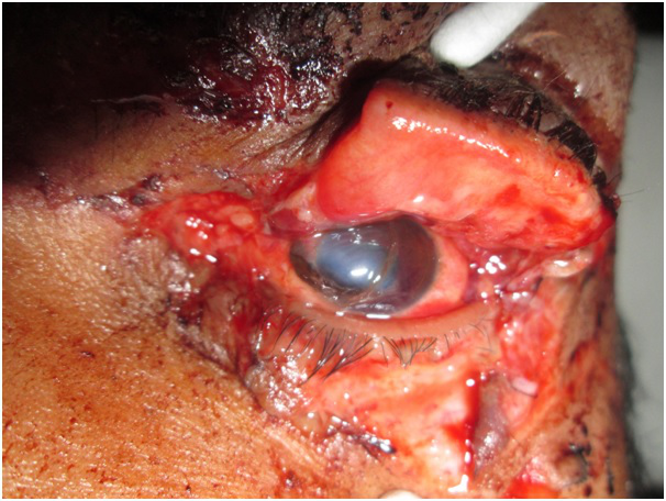 Canalicular laceration extending to upper lid with corneoscleral laceration