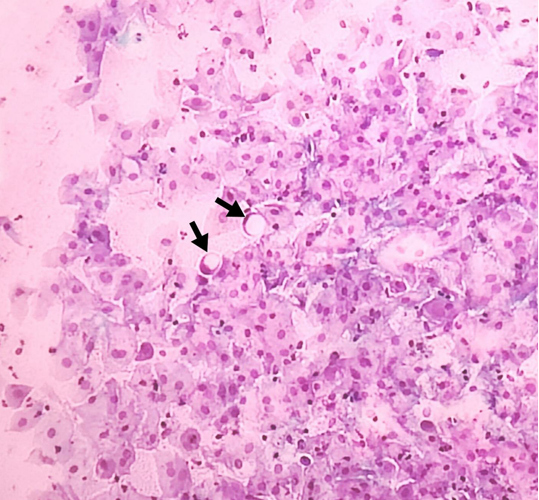 Black arrow showing single scattered signet ring cells. (Pap 1400X1300).