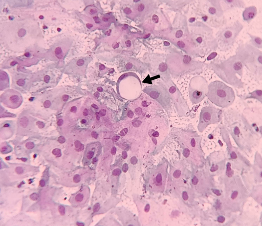 Signet ring cell morphology in the epithelial cell.(Pap 1500X1300).