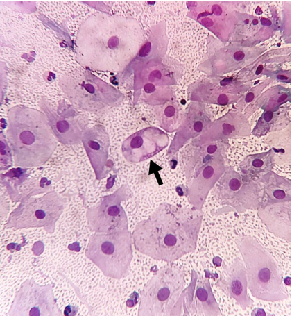 Multiple vacuoles forming cytoplasmic aggregates in the squamous epithelial cell which is related to artifactual changes (Pap 1200X1300).