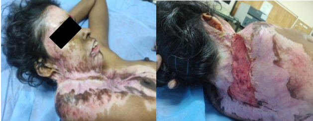 Post burn contracture neck with non-healing ulcer over back