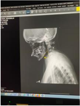 Cervico-mental angle at 46 degrees at time of presentation