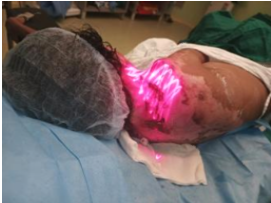 Low level laser therapy applied to the wound