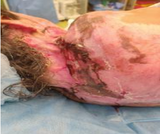 Skin grafting done for non-healing ulcer