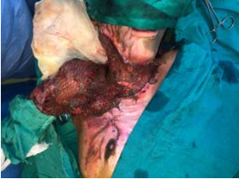 Contracture release and split thickness skin grafting done & taken well