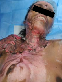 Split thickness skin graft taken up well at the site of contracture released