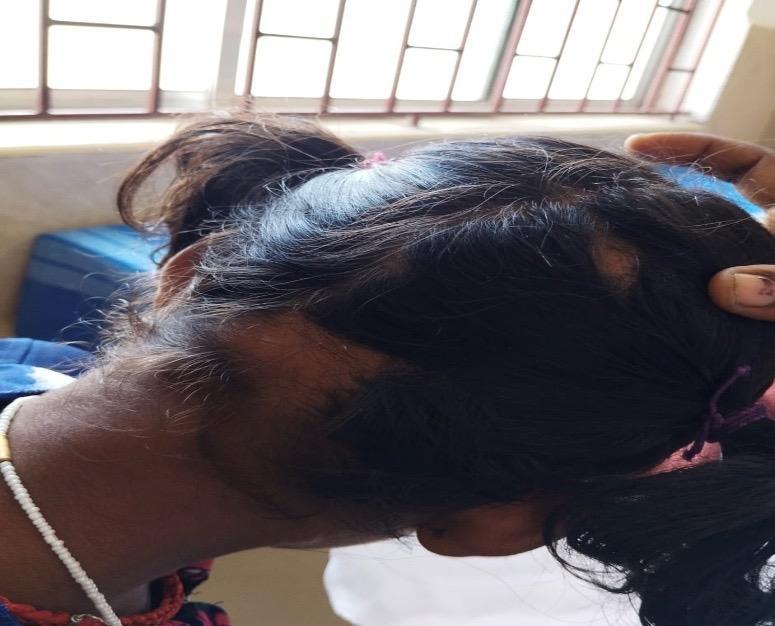 The image above shows alopeciaareata in a 10 year old female child
