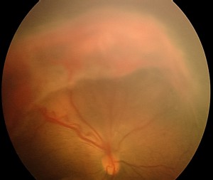 Subtotal retinal detachment not involving macula