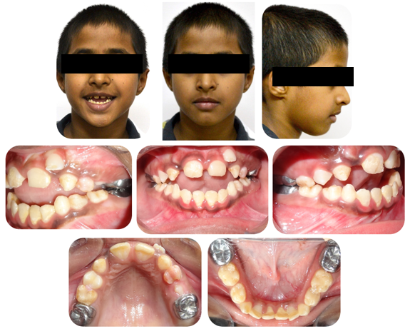 Pre-treatment extra-oral and intra-oral photographs