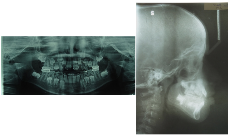 Pre-treatment OPG and Lateral Cephalogram