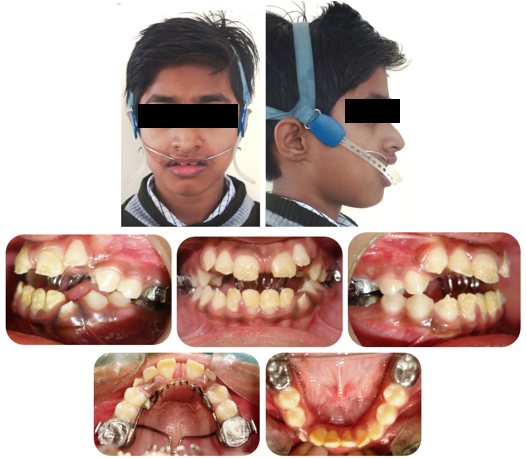 Phase 1 mid treatment extra and intra-oral photographs