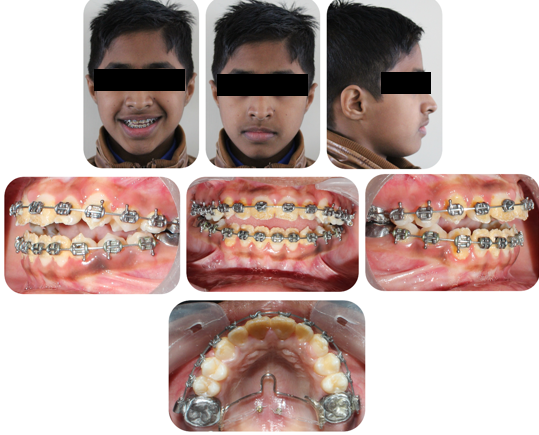 Phase 2 mid treatment extra and intra-oral photographs