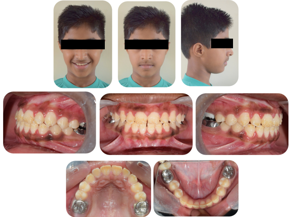 Post debond extra and intra-oral photographs