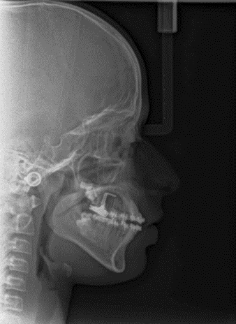 End treatment lateral cephalogram